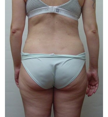 abdominoplasty back view after